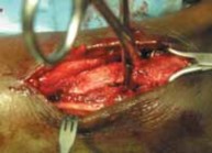 Illustration 39 for Optimal Fixation of the Ankle: Open Reduction & Internal Fixation