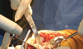 Illustration 19 for Mastering Gap Balancing in Revision TKA: Avoid Common Pitfalls