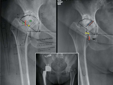 Illustration 12 for Maximize Success: Preoperative planning in primary Hip Replacement