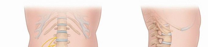 Meralgia Paresthetica: Relief for Lateral Femoral Cutaneous Nerve Pain