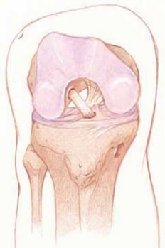 Illustration 82 for Optimizing Single-Bundle Anterior Cruciate Ligament Repair