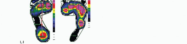 Illustration 6 for How Achilles Tendon Lengthening Fixes Equinocavovarus Foot