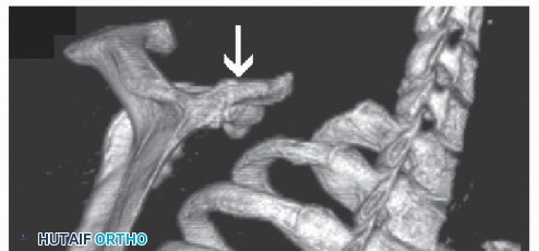 Illustration 6 for Snapping Scapula Syndrome: Why Your Shoulder Clicks & What to Do