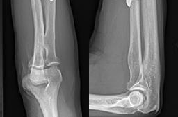 صورة توضيحية لـ علاج كسور العظام المتقدمة وعملية التئامها: دليل شامل من الأستاذ الدكتور محمد هطيف في صنعاء