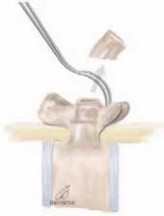 Illustration 13 for Optimizing Instrumentation for Neuromuscular Scoliosis