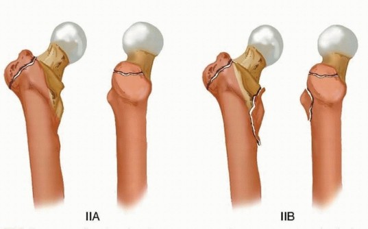 Illustration 9 for Achieve Optimal Femoral Head Fixation with Cephalomedullary Nailing
