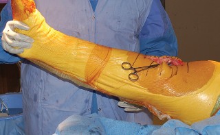 Illustration 46 for Mastering Gap Balancing in Revision TKA: Avoid Common Pitfalls