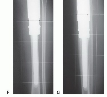 Illustration 49 for Tackling Complex Tumors of the Proximal Tibia: Limb-Sparing Solutions