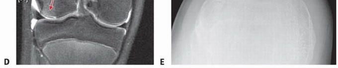 Illustration 4 for Chronic Patellar Instability: From Acute Onset to Lasting Solutions
