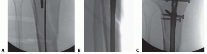 Illustration 45 for Advanced Nailing of the Mature Tibia: Overcoming Complexities