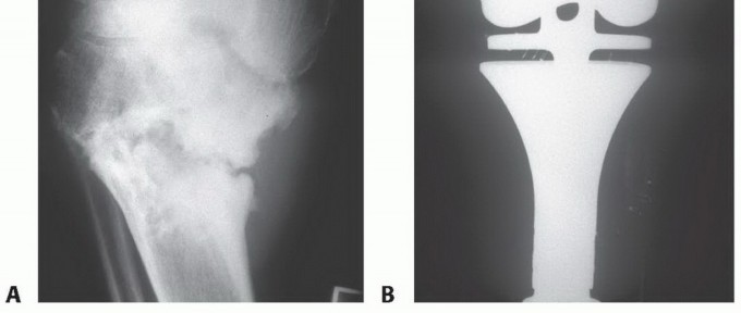 Illustration 27 for Avoid Major Surgery: Bone Tumor Treatment with Liquid Nitrogen Pour