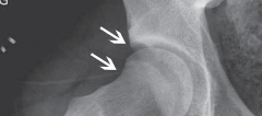 Illustration 40 for Resolving Femoral Head Neck Impingement: Arthroscopic FAI Solutions