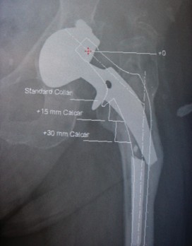 Illustration 10 for Templating for Revision: Navigate Complex Hip Arthroplasty