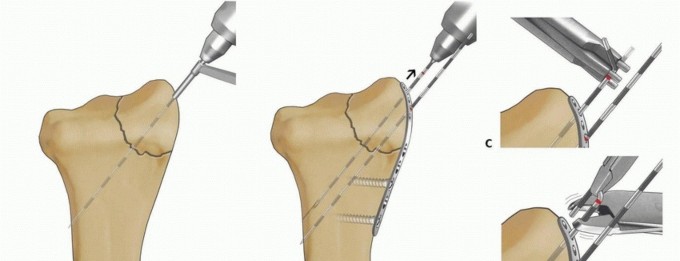 Illustration 32 for Fragment-Specific Fixation: Restore Carpal Facet Horizon