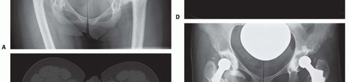 Illustration 5 for Special THA Techniques for Severe Deformities Around the Hip