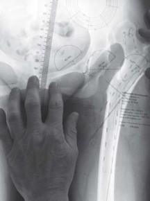 Illustration 20 for Successful Total Hip Replacement in Developmental Dysplasia