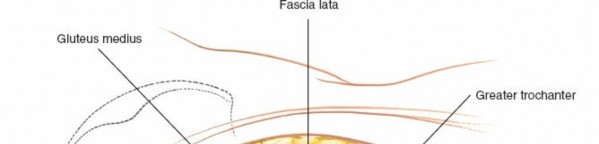Illustration 121 for Pelvis & Acetabulum Approaches: Unlocking the Posterior Superior Iliac