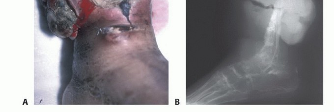Illustration 19 for Precision Biopsy of Musculoskeletal Tumors for Accurate Diagnosis