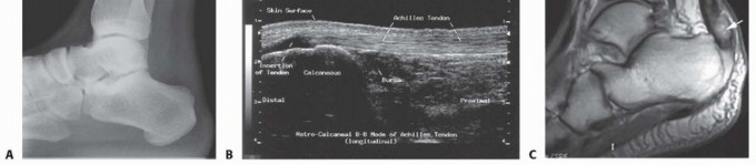 Achilles Tendon Repair: Master Your Early Recovery Journey