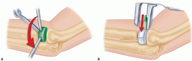 Illustration 19 for Radial Head Arthroplasty: Restoring Elbow Function & Stability