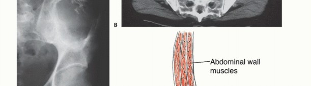 Illustration 49 for Pelvic Metastasis Surgery: A Component of the Utilitarian Approach