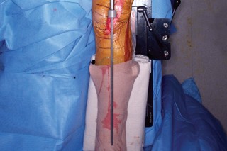 Illustration 34 for Mastering Valgus Total Knee Replacement: Techniques & Pitfalls