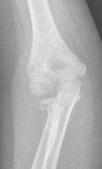 Mastering Joystick & Intramedullary for Radial Neck Fractures