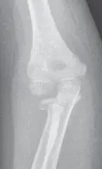 صورة توضيحية لـ كسر عنق الكعبرة لدى الأطفال والكبار: دليلك الشامل للتشخيص والعلاج والتعافي في اليمن