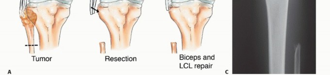 Illustration 25 for Beyond Amputation: The Type I Resection in Fibular Tumor Surgery