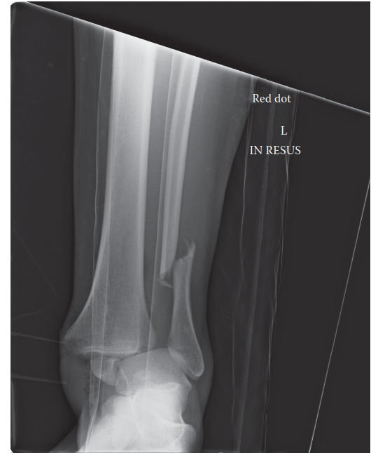 Illustration of case ankle fracture case - Dr. Mohammed Hutaif