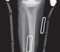 Illustration 49 for PROSTALAC Articulating Spacer: Treat Infected Knees, Regain Mobility
