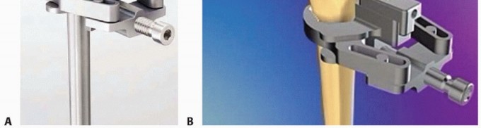 Illustration 19 for Hemiarthroplasty for Proximal: Effective Treatment for Fractures