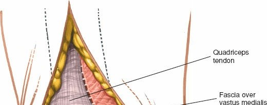 Illustration 32 for Mastering Knee Approaches: Spotlight on Superficial Medial Ligament