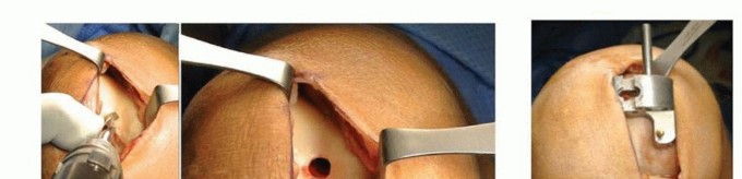 صورة توضيحية لـ استبدال مفصل الركبة الجزئي: حل متقدم لآلام الركبة المستمرة مع الأستاذ الدكتور محمد هطيف