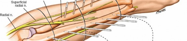 Illustration 6 for Key Approaches for External Fixation: Humerus, Radius, Ulna, Wrist