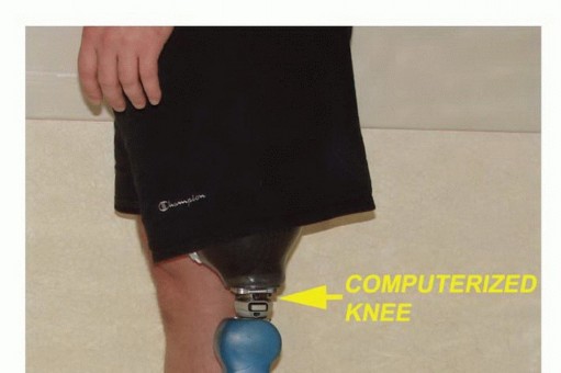 Illustration 26 for Mastering Above-Knee Amputation: Essential Surgical Insights