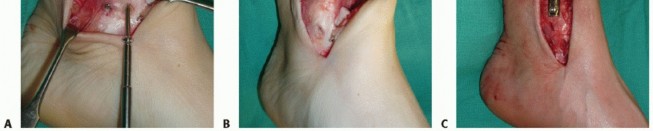 Illustration 31 for Painful Talus Lesions? The tech fig c Osteochondral Transfer Solution