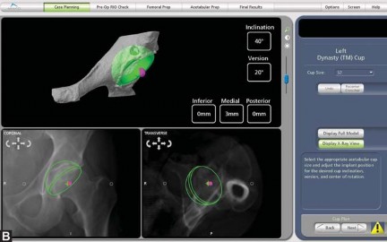 Illustration 7 for Robotics in Total Hip Arthroplasty: A New Era of Precision