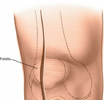 Illustration 30 for Mastering Knee Approaches: Spotlight on Superficial Medial Ligament