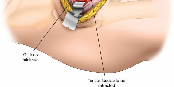 Illustration 88 for Unlocking Every Aspect of the Hip's Surgical Approaches