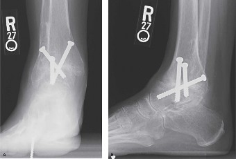 Illustration 2 for Ankle Arthritis Case: Easing Painful Plantar Flexion Hindfoot