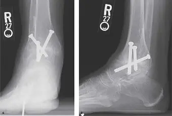التهاب مفصل الكاحل المزمن: دليل شامل للتشخيص والعلاج مع الأستاذ الدكتور محمد هطيف