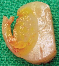 صورة طبية: مراجعة استبدال الركبة الجزئي الفاشل دليلك الشامل للعلاج الناجح في صنعاء