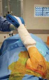 Illustration 9 for Arthroscopic Subscapularis Repair: The lo iky brady Method for Stability