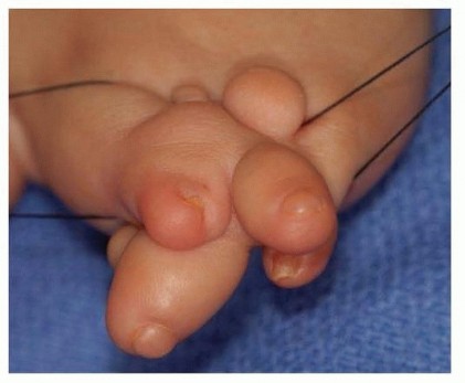  Amniotic Band Syndrome