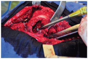 Illustration 46 for Cement in Cement Revision: Simplifying Complex Hip Revisions