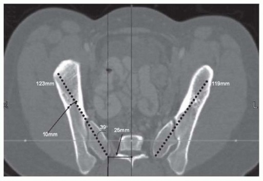 Pelvic Fixation: Better Outcomes for Patients with NMS