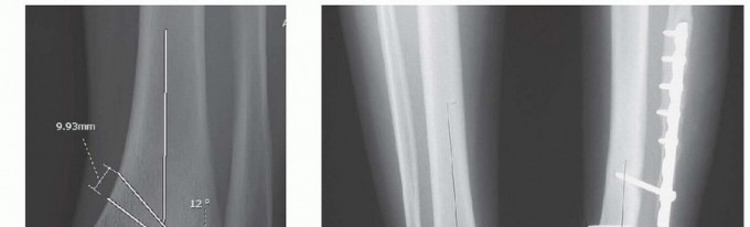 Illustration 2 for Distal Tibial Osteotomy: Fixing Varus & Valgus Ankle Alignment