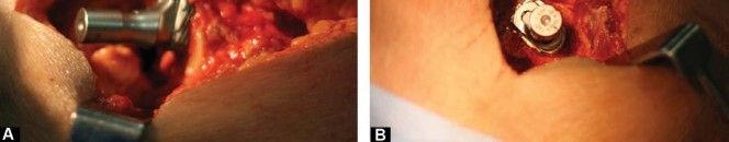 Illustration 16 for Considering METHA Short Stem? Discover Bone-Preserving THA