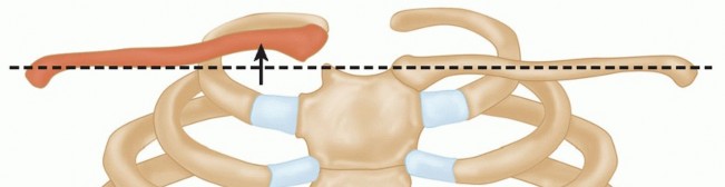 Illustration 10 for Optimizing SC Dislocation Repair After Medial Clavicle Resection